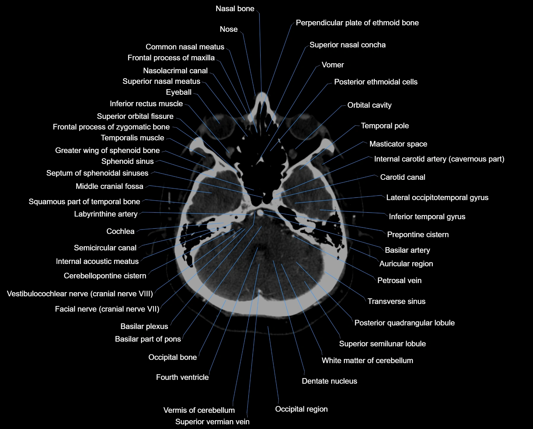 CT scan brain axial labelled cross sectional anatomy image-img-000018.webp